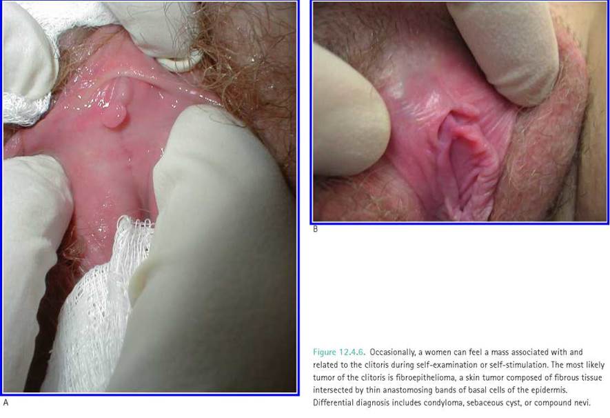 A vulva (clitoris) rákja - okai, tünetei, kezelése