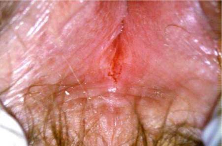 What is a vaginal fissure