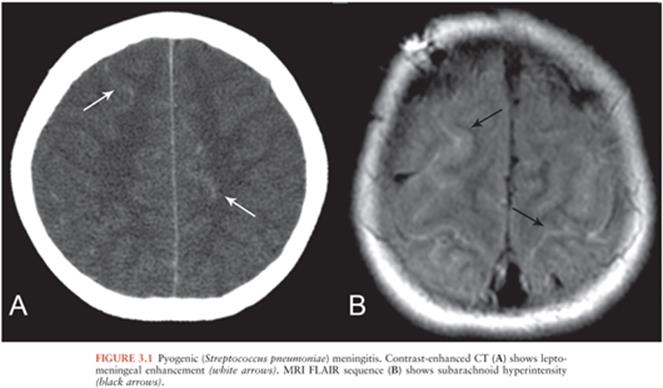 Featured image of post Cerebritis On Mri Magnetic resonance mr imaging is more sensitive than ct in the detection of brain abscess because it has encephalitis cerebritis and brain abscess