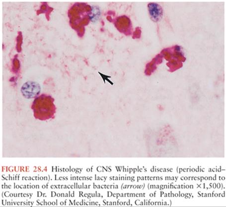 whipple bacteria ie causes of rectal cancer hpv