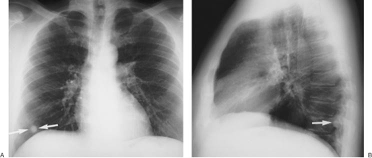 Solitary And Multiple Pulmonary Nodules Chest Radiology The