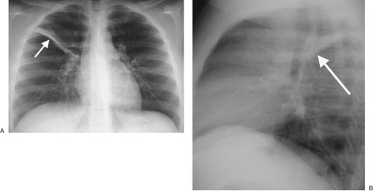 Basal Atelectasis X Ray