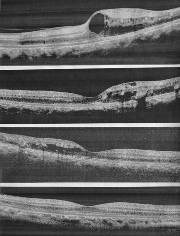 Figure 12.3—Spectral domain optical coherence tomography with the lower scan showing a healthy macular area in the center