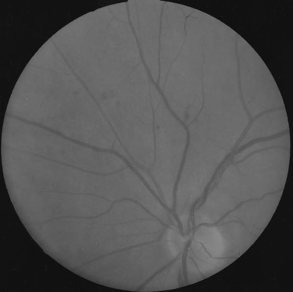 Figure 12.4—There are fine red dots and blotches in the upper left part of this retinal photo