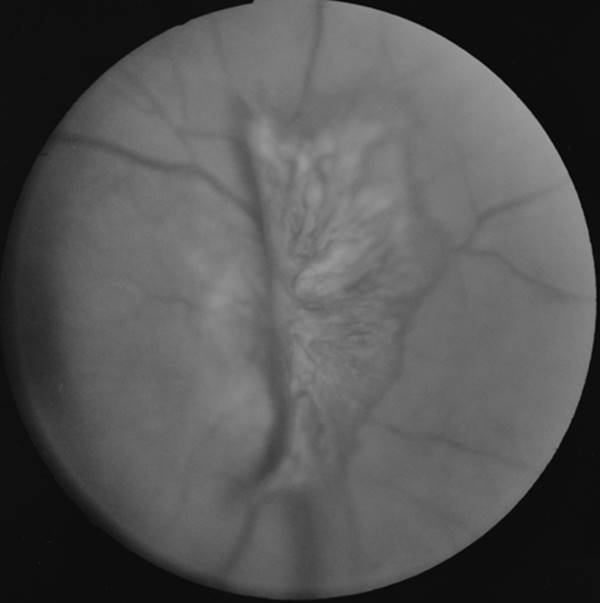 Figure 12.5—A patch of new vessels is growing up out of hte optic disk in PDR
