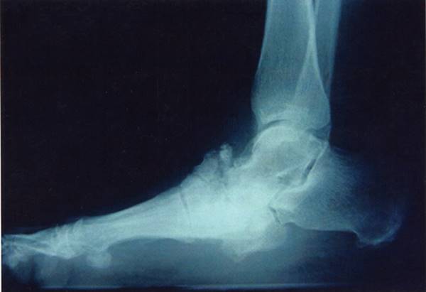 Figure 17.3—Charcot foot