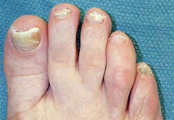 Figure 17.5—Fungally infected nails present with thickness, discoloration, and subungual debris