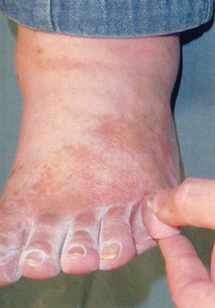 Figure 17.7—Web spaces of toes may retain moisture, which causes maceration