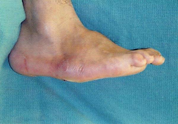 Figure 17.8—Collapse of the midfoot in Charcot foot will result ina rocker bottom deformity