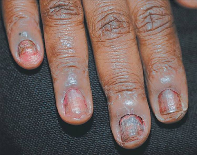 Disorders of the Nail Apparatus - Fitzpatrick's Color Atlas and Synopsis of  Clinical Dermatology, Seventh Edition
