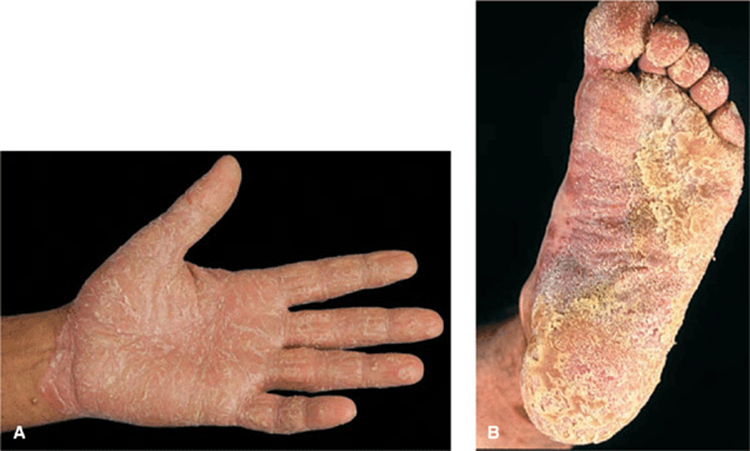 psoriasis fissures pictures)