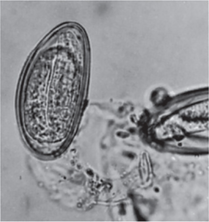 enterobiasis pinworm