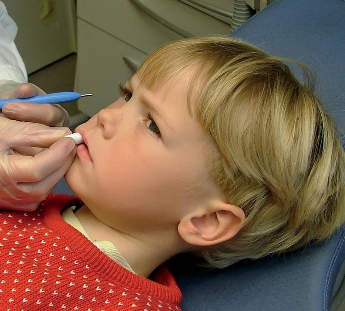 Photo displaying a gloved hand placing fissure sealants on a boy’s first permanent molars.
