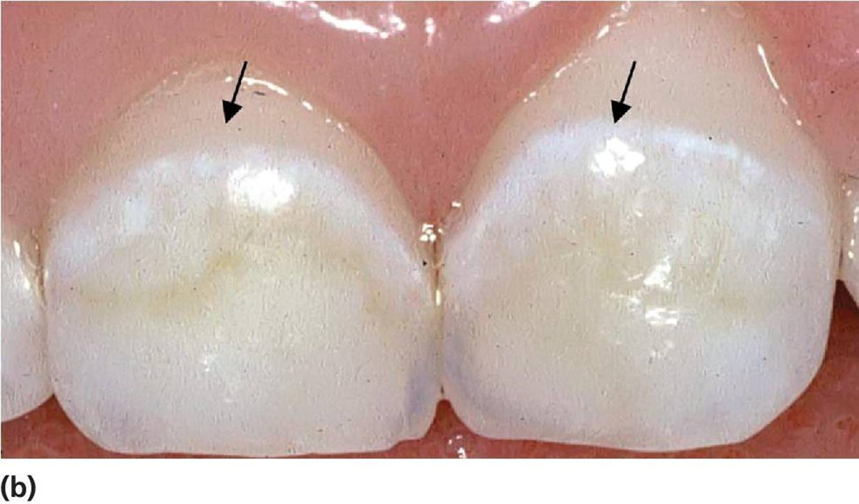 Photo displaying arrested noncavitated lesions on the buccal surfaces of primary upper incisors in a 4-year-old.