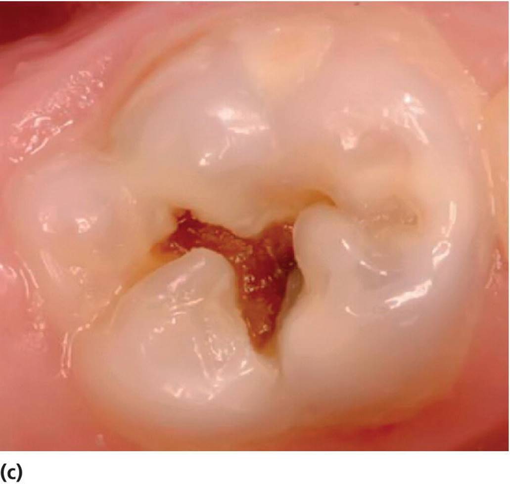 Photo displaying active cavitated lesion in a primary lower second molar in a 5-year-old.