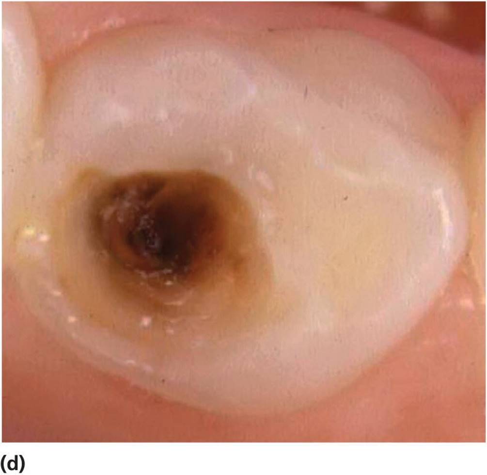 Photo displaying inactive (arrested) cavitated lesion in a primary lower first molar in a 7-year-old.