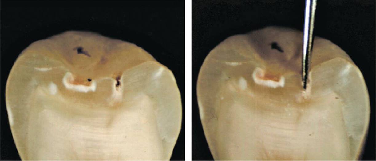 Two photos of a sectioned premolar with an enamel caries lesion in the fissure before probing (left) and during intense probing (right).