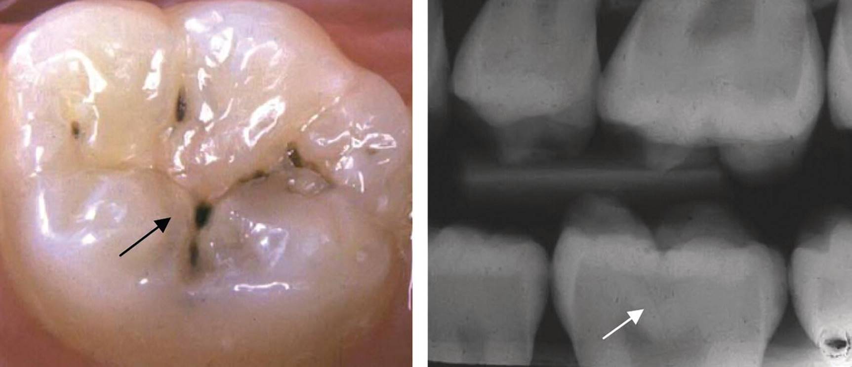 Photo of a permanent first molar tooth with a small but obvious occlusal cavity (left) and radiograph displaying a substantial radiolucency in the dentin (right).