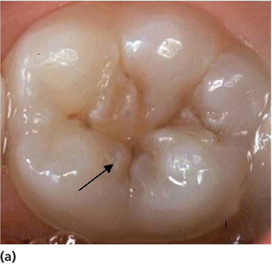 Photo displaying a discolored fissures in a permanent first molar of an 8-year-old child, with softened enamel at the entrance of the fissure indicating an active lesion.