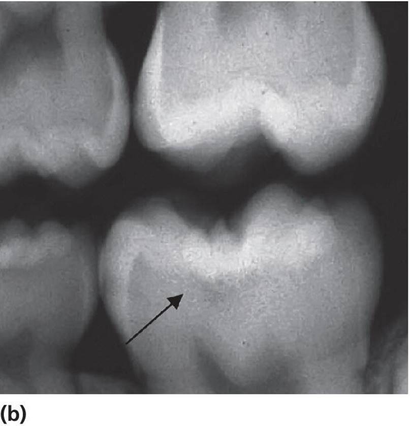 Radiograph displaying radiolucency in the dentin, indicated by an arrow.