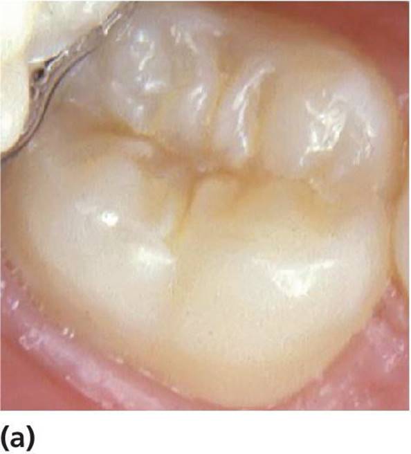 Photo displaying a permanent lower second molar in a 14-year-old child, with no signs of caries.