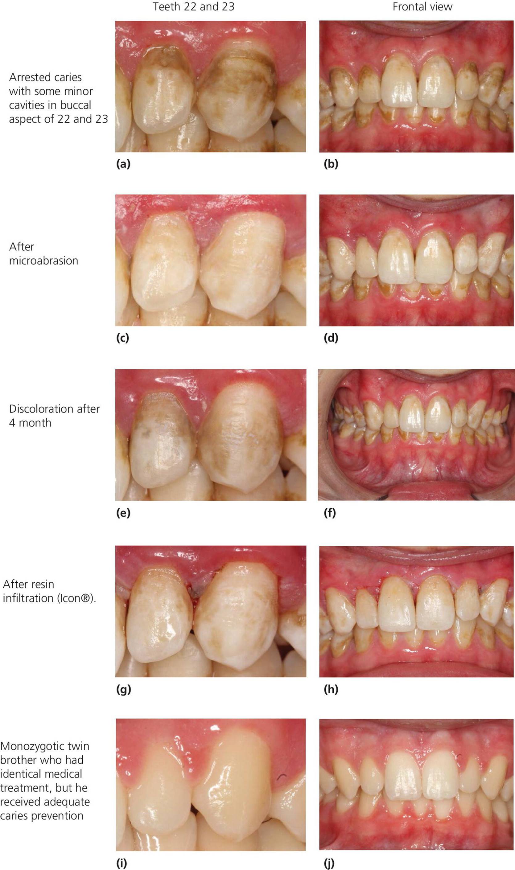 Photos of teeth 22 and 23 (left) and fontal views (right), (a,b) with caries and cavities, (c,d) after microabrasion, (e,f) discoloration after 4 month, (g,h) after resin infiltration, (i,j) and of the twin brother.