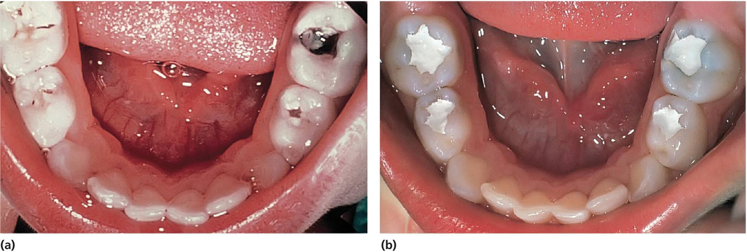 Two photos displaying the mandibular teeth of a 3-year-old boy with high caries activity (left) and after gross excavation of the caries lesions and application of a temporary zinc oxide–eugenol cement (right).