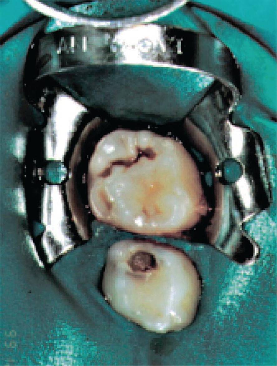 Photo displaying rubber dam used for isolating the operation field before restorative therapy of primary molars.