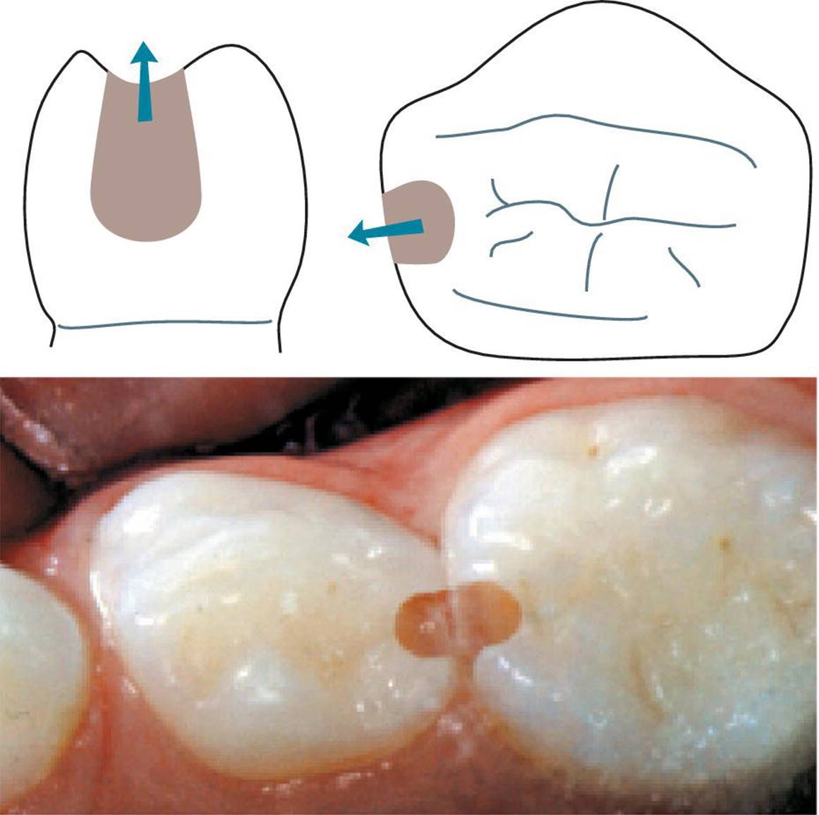 Top: Illustration of the primary molar teeth with cavity outline represented by shaded areas and arrows indicating the direction. Bottom: Photo of primary molars teeth with small cavities removed.