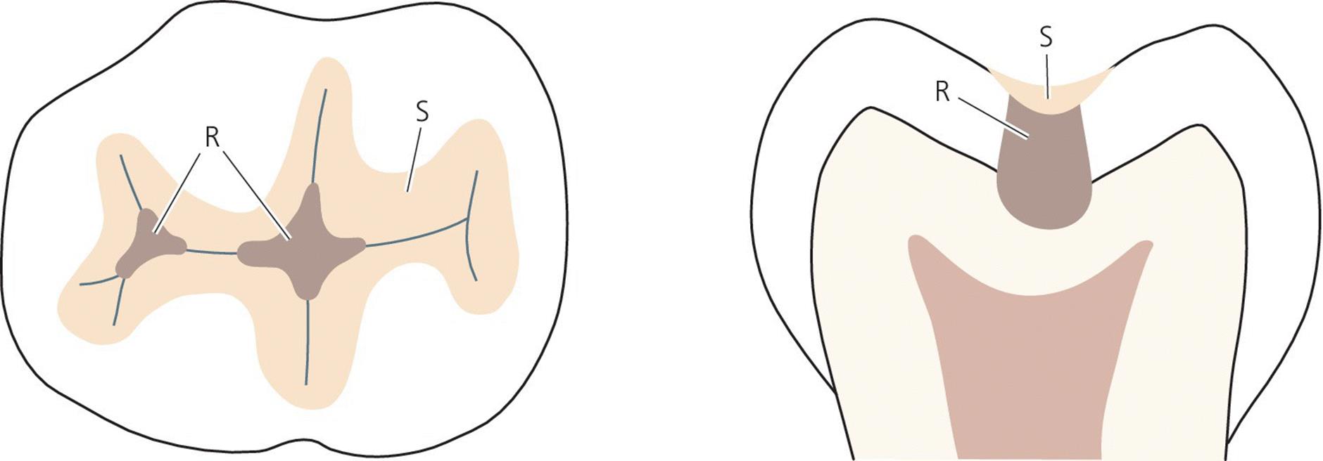 Two illustrations of the tooth in occusal (left) and cross-sectional views (right), depicting preventive resin/GIC restoration.