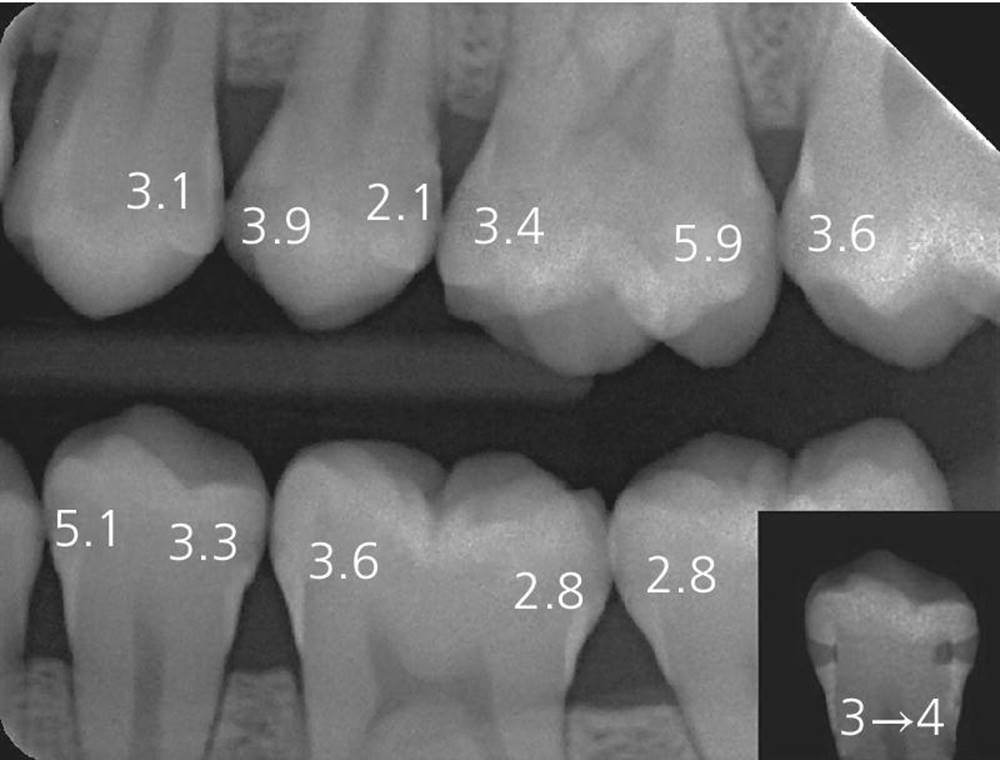 Graph illustrating cumulative survival curves of occlusal surfaces from radiographically sound to obvious radiolucency in dentin, depicted by 2 descending lines labeled 0.68 (1st molars) and 0.55 (2nd molars).