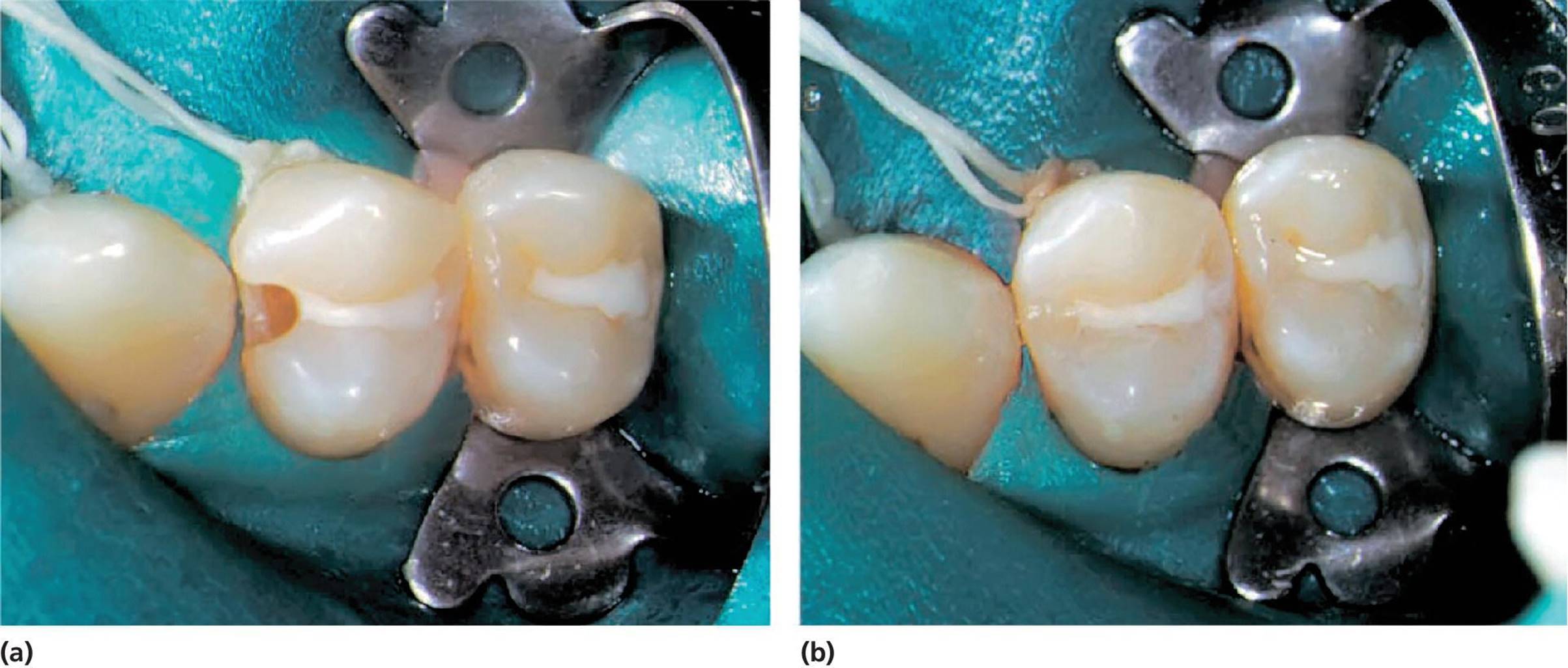 2 Photos displaying saucer-shaped cavity design before filling (left) and after filling with a composite resin (right).