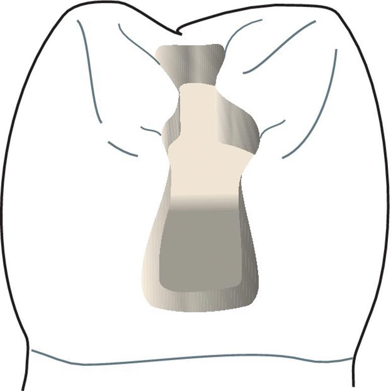 Illustration of a tooth in conventional Class II amalgam preparation with minimal buccal–lingual extension.
