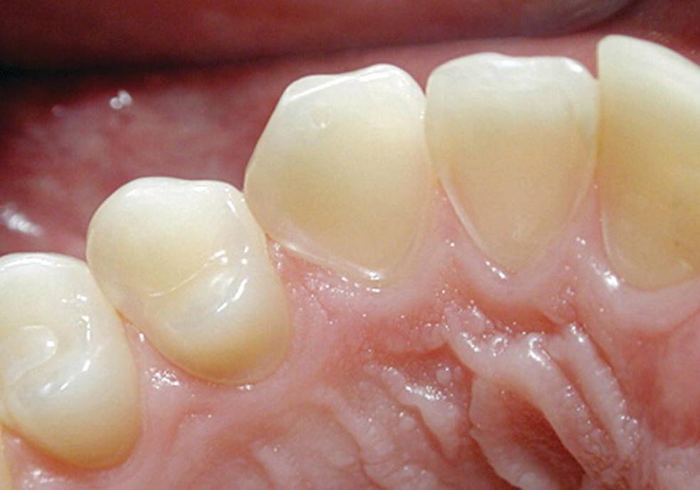 Photo displaying severe erosion on the palatal surface of the upper incisors with the enamel close to the gingival margin being intact.