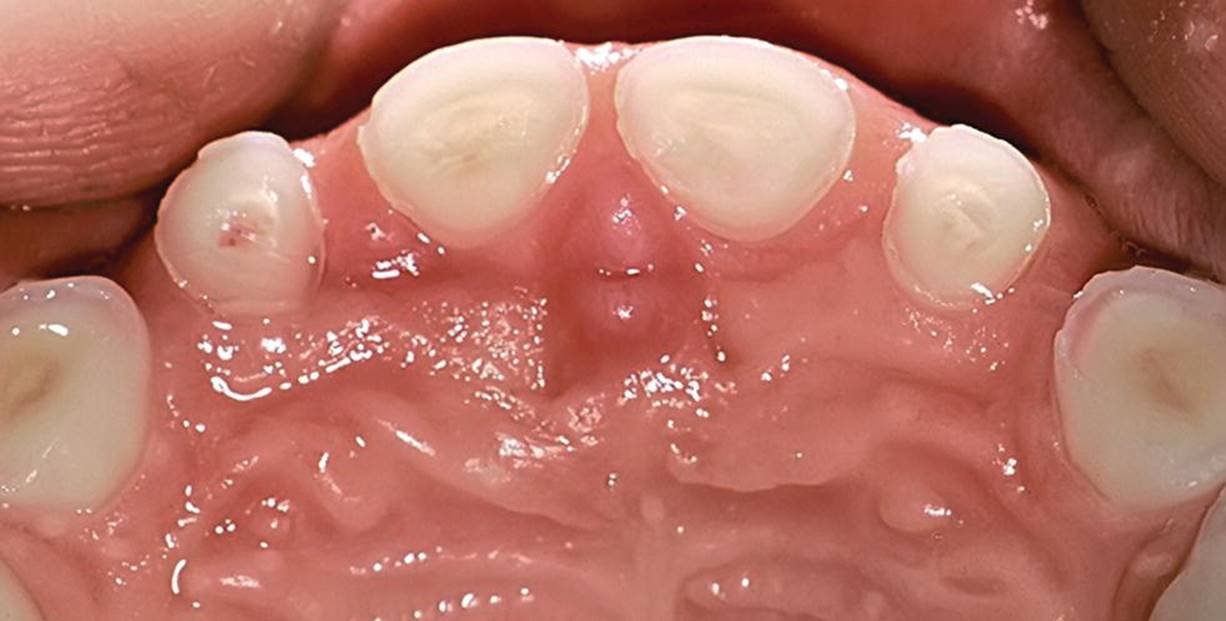 Photo displaying near-to-pulp exposure on the palatal surfaces of anterior primary teeth featuring secondary and tertiary dentin.
