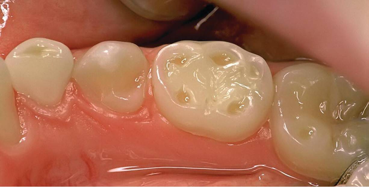Photo displaying clinical signs of erosion: cuppings on primary molars (teeth 83 and 85) and permanent molar (tooth 46).