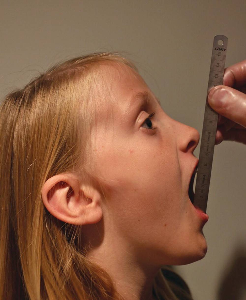 Photo of a patient whose maximal jaw opening capacity is being measured with a ruler.