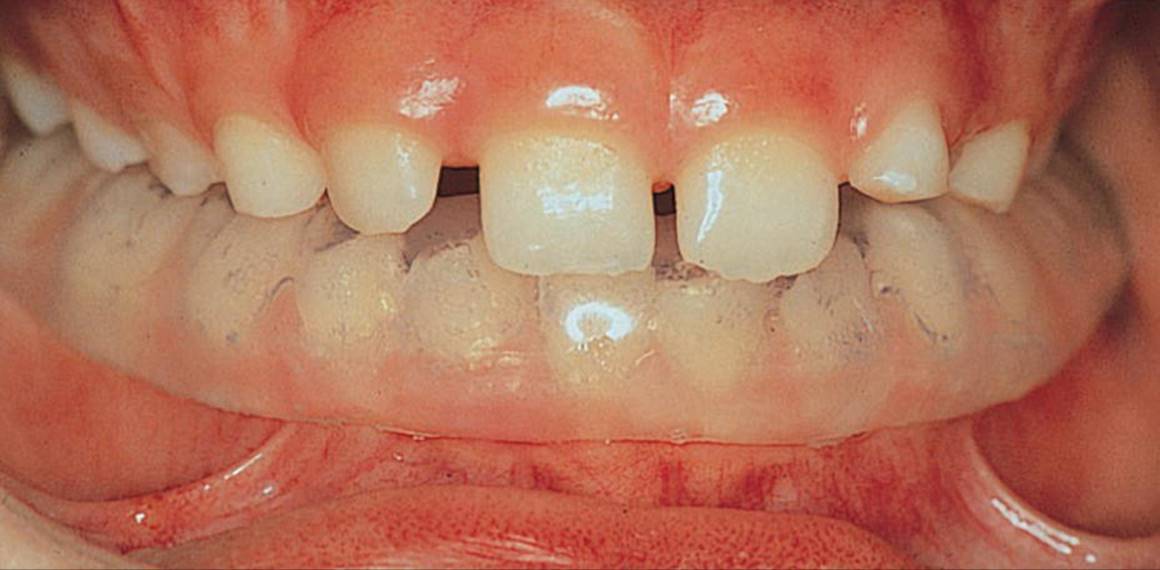Photo of a human dentition with soft interocclusal appliance placed in the mandible.