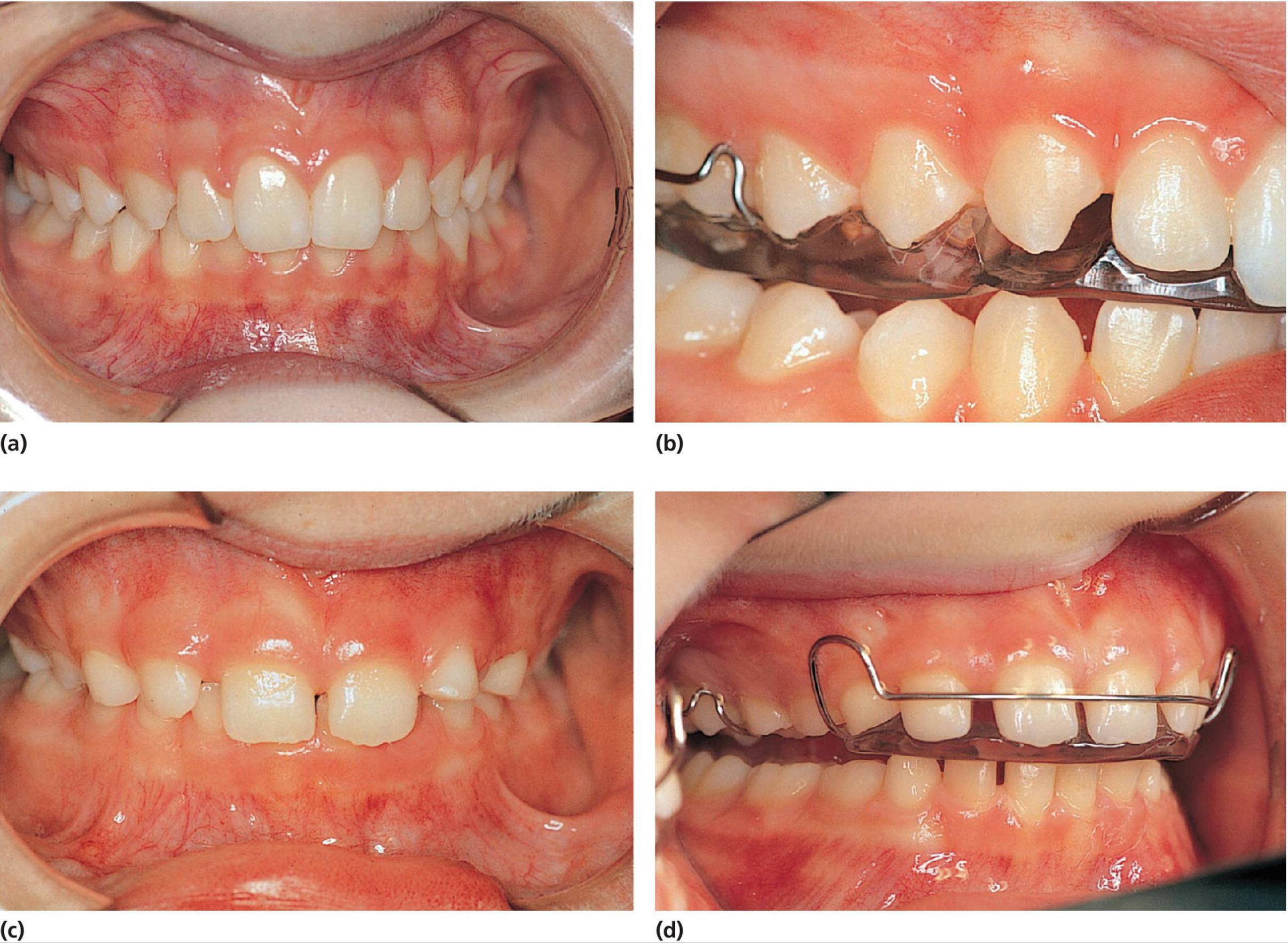 Four photos featuring a 12‐year‐old girl’s canines in the maxilla, a hard acrylic appliance (shore‐plate), a 7‐year‐old boy with mixed dentition and a deep bite, and hard acrylic bite‐plate to prevent teeth wear.