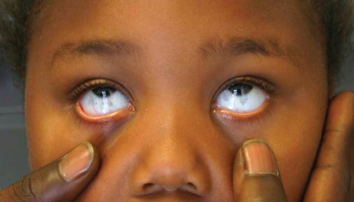 Discoloration of/Around the Eye - Visual Diagnosis and ...