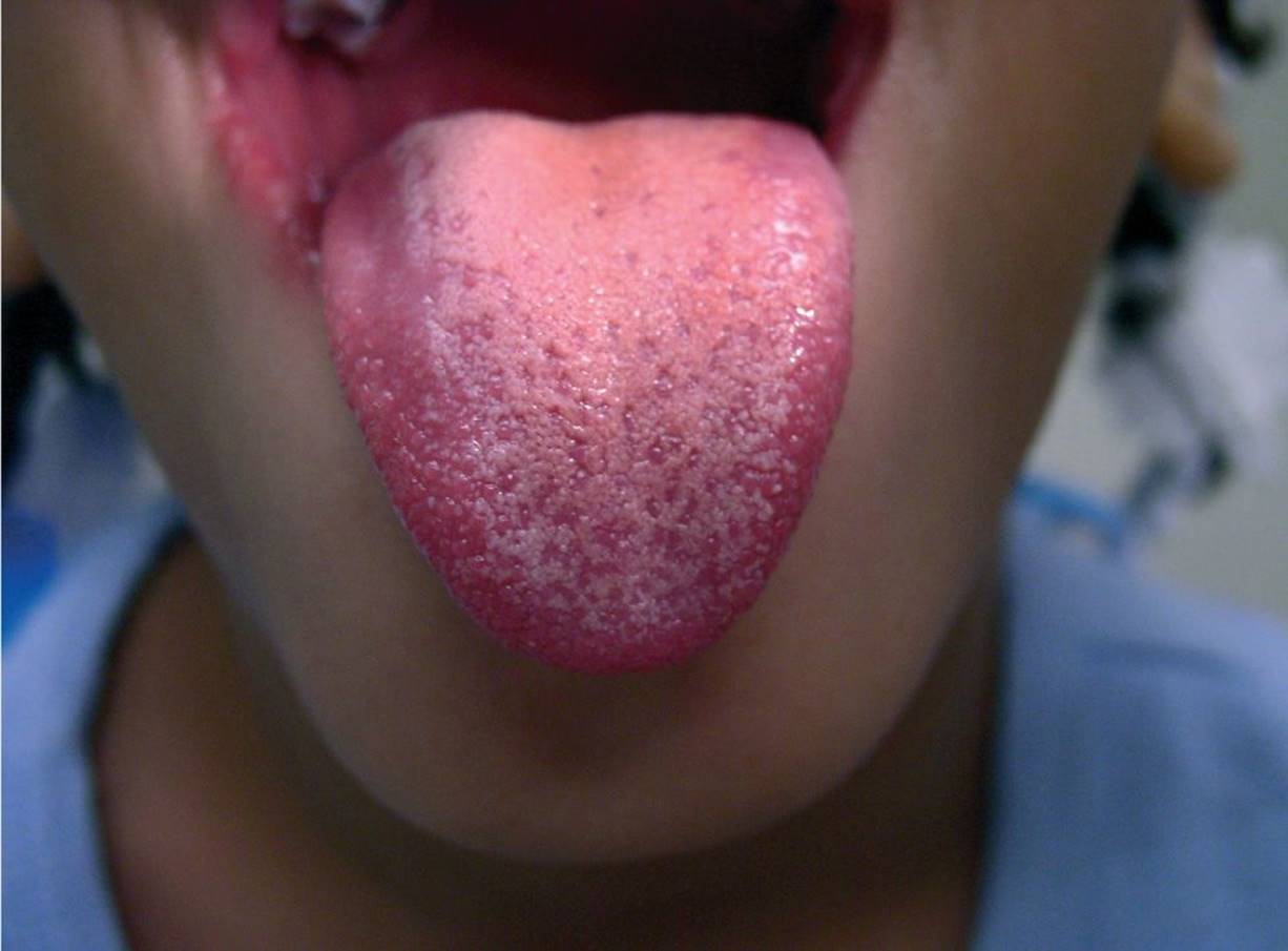fungiform papillae tongue treatment negi genitale