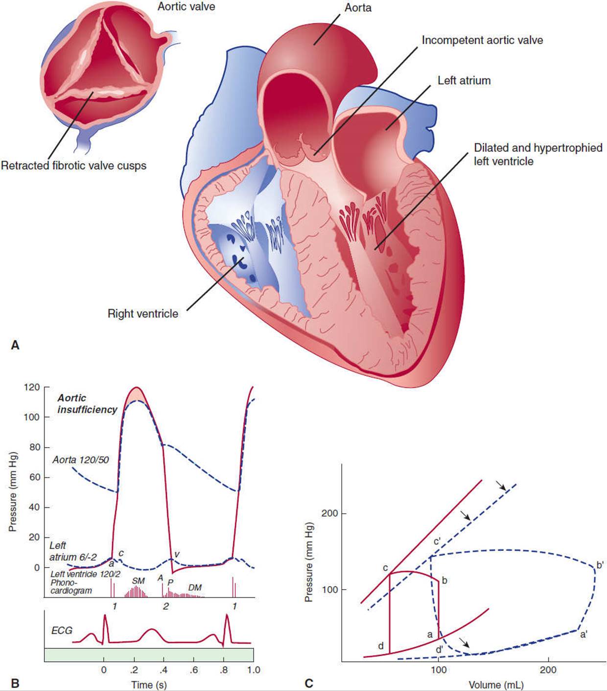 Cardiovascular Disorders: Heart Disease - Pathophysiology of Disease ...