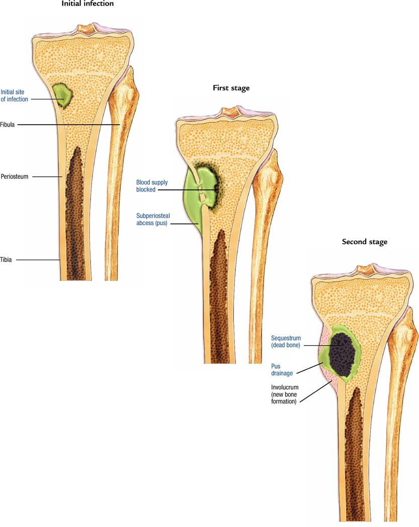 Osteomyelitis Bone Infection