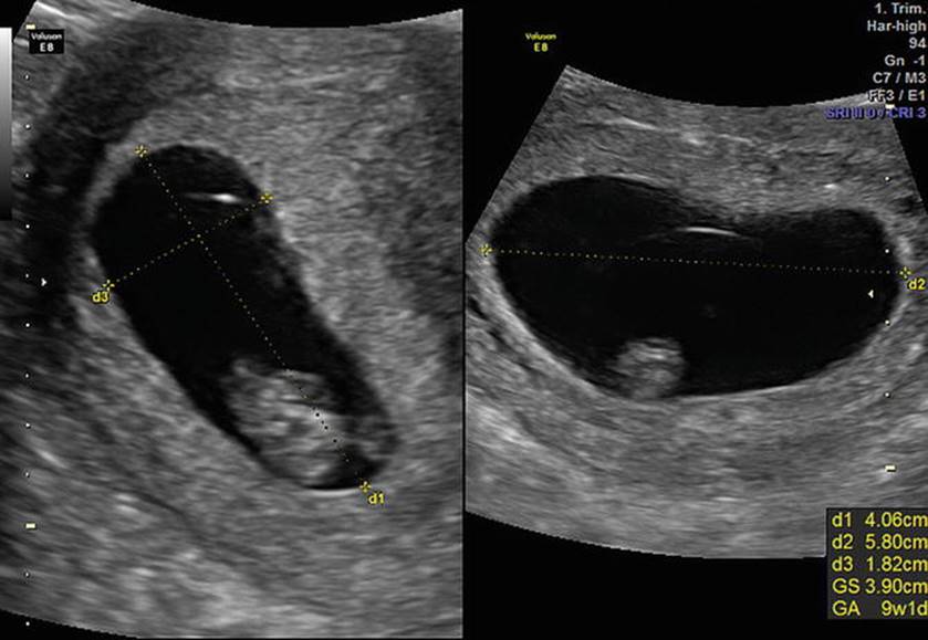 Us obstetric nuchal dating scan in Baltimore
