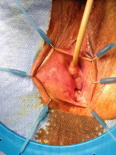Marsupialization of bartholin's cyst is surgery. 