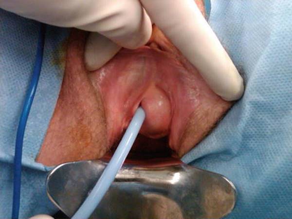 Excision of Vaginal Cysts - Female Pelvic Surgery